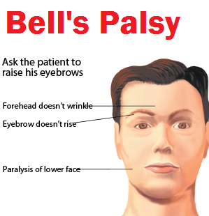 Bad M. F. reccomend Idiopathic facial palsy