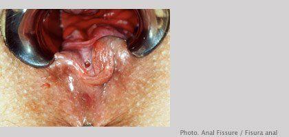 Painful anus during bowel movements