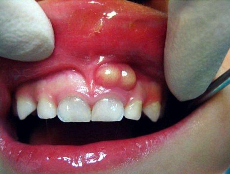 Dental caries facial abscess