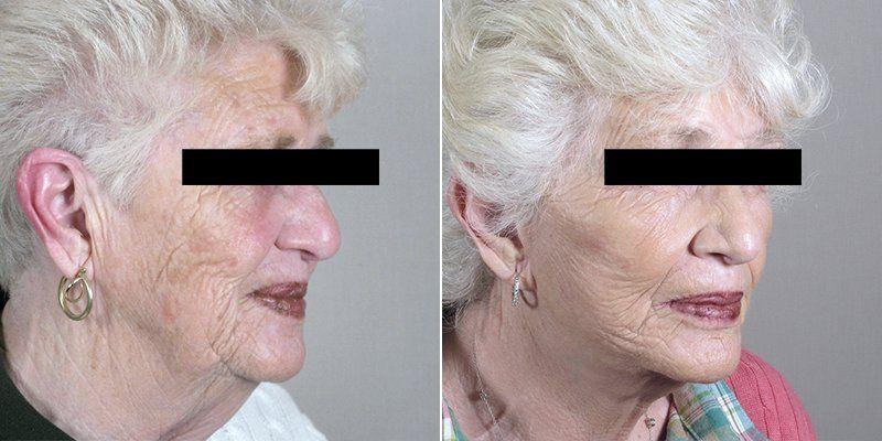 best of Wrinkles Cosmetic surgery for facial