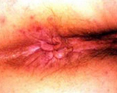 best of Lesions anus Burning on