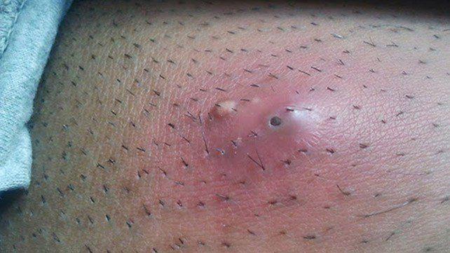 Scratch reccomend Bumps on pubic hair near anus