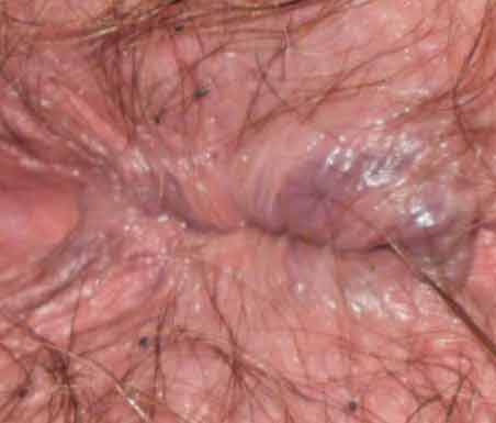 Bumps on pubic hair near anus