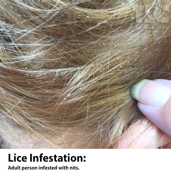 Maple reccomend Adult lice picture