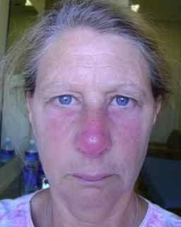 Squeaker reccomend Facial swelling from sinus infections