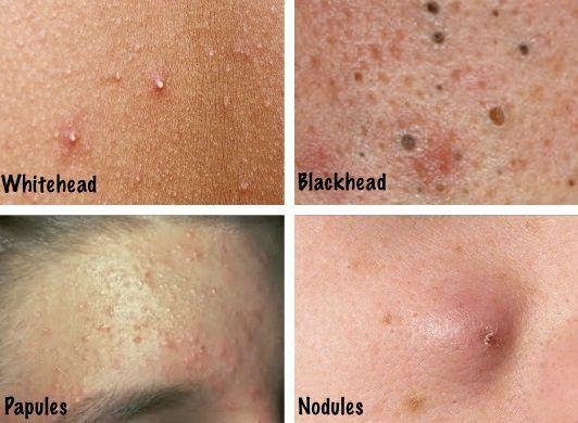 Tailgate reccomend Types of facial acne