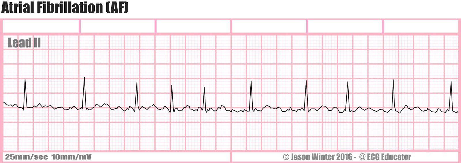 X reccomend Atrial tachycardia rhythm strip