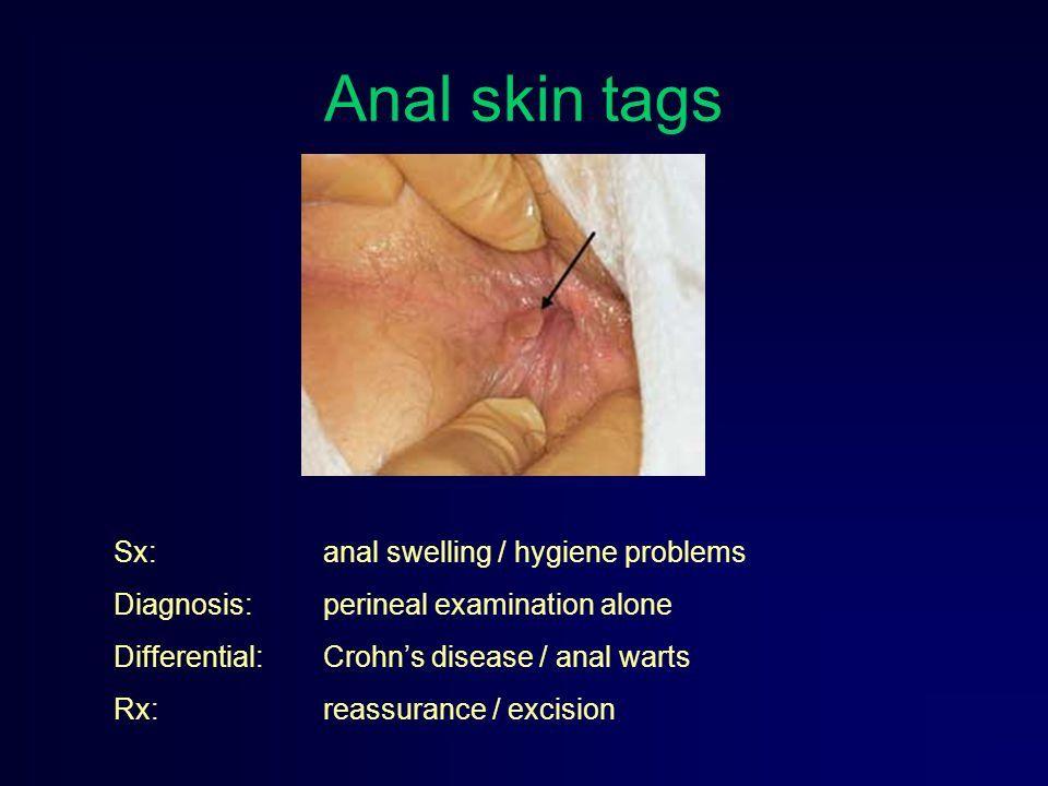 Thunderbird reccomend Anal skin tag vs anal wart