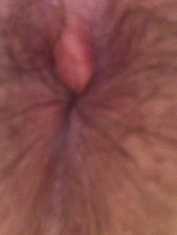 Lumps in the anus