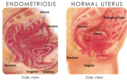 best of Clitoris Endometriosis in the