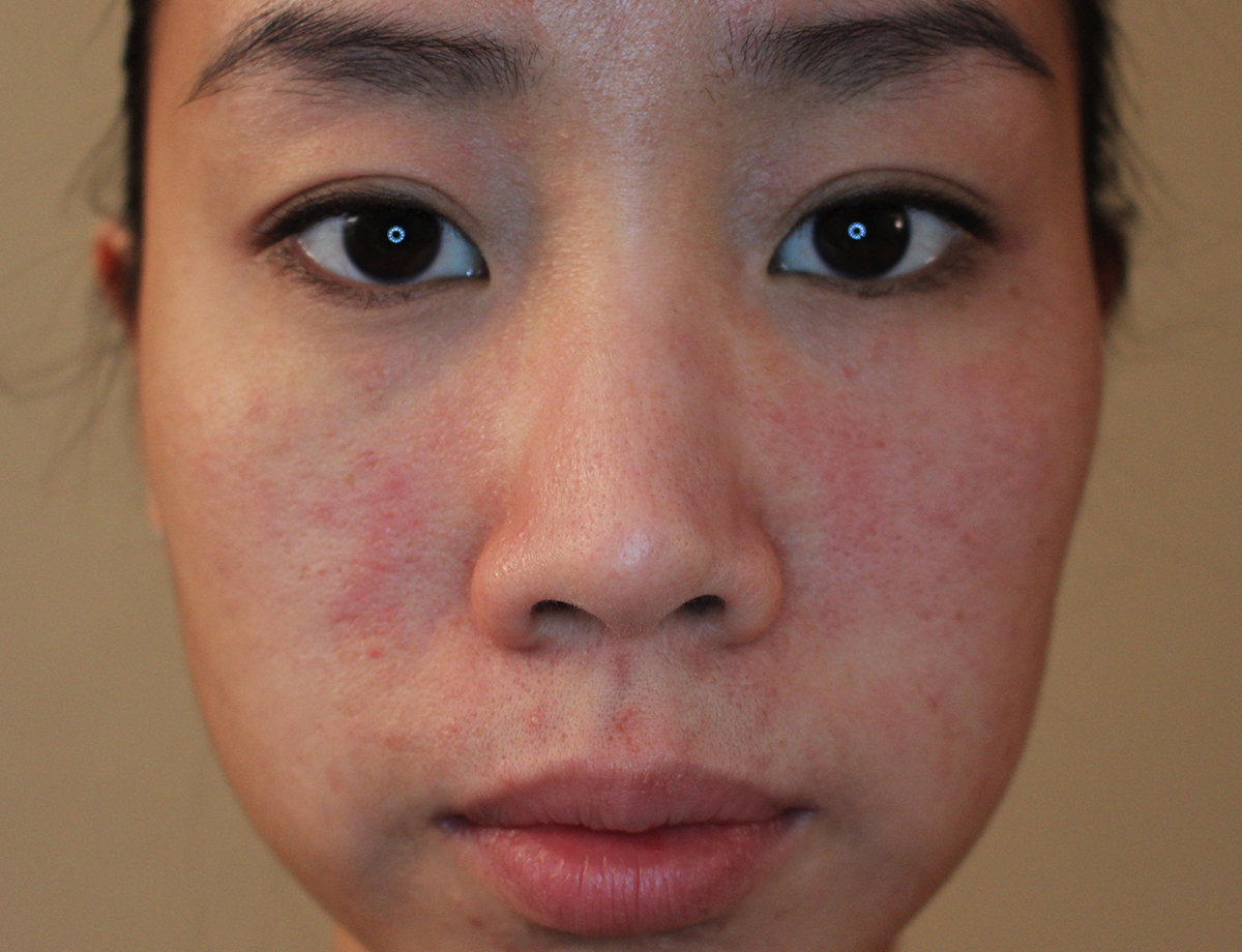 Jetta reccomend Facial allergic reation