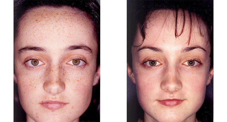 Flurry reccomend Facial peel for acne