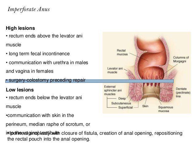 Fry S. reccomend Pediatric imperforate anus