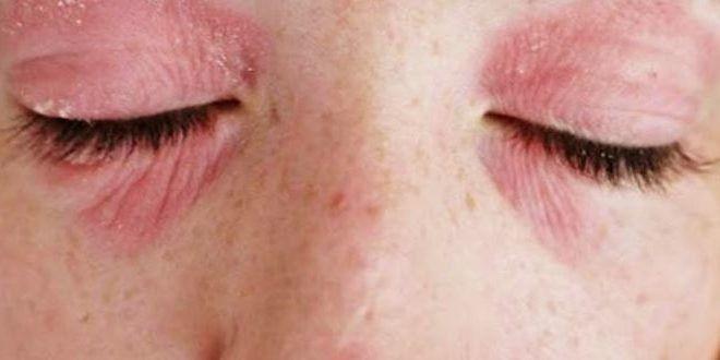 best of Facial rashes skin lid Eye