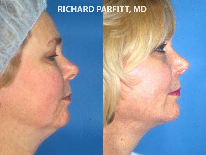 Pipes reccomend Facial implants chicago