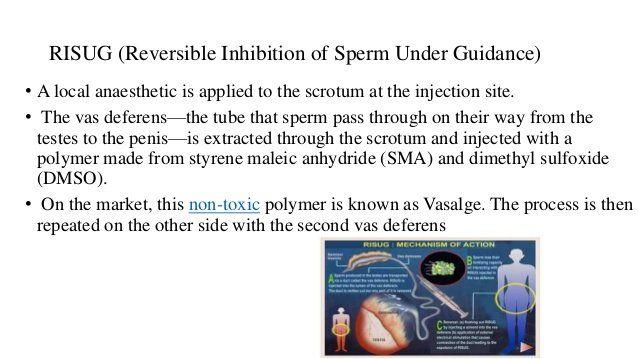 Reversible inhibition of sperm under guidance