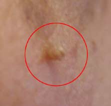 Punkin reccomend Flap of skin inflamed near anus