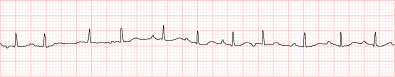 Atrial tachycardia rhythm strip