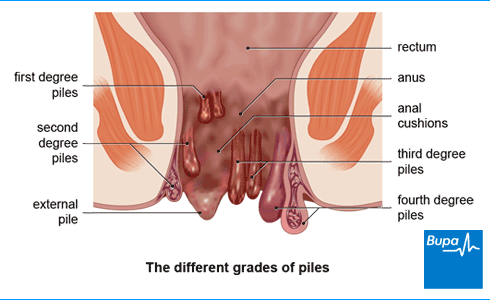Protruding painful veins anus