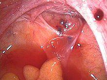 Endometriosis in the clitoris