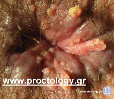 best of Warts hpv Pictures of anal