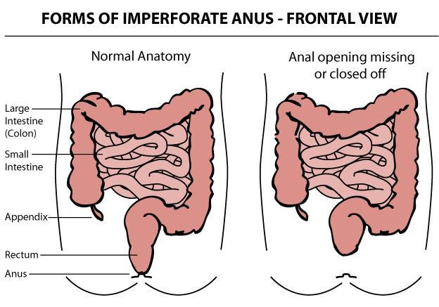 Rover reccomend Pediatric imperforate anus