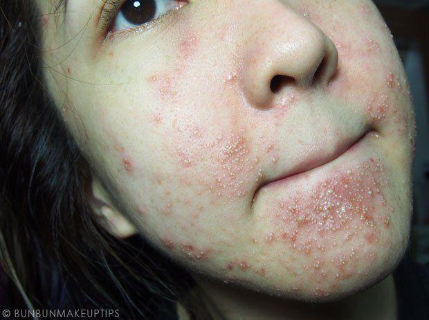 Snout reccomend Facial allergic reation