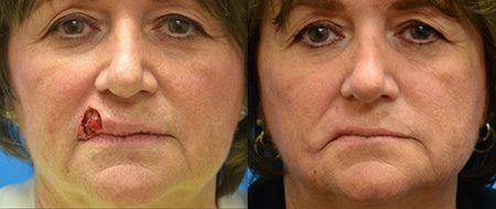 Facial reconstructive surgery