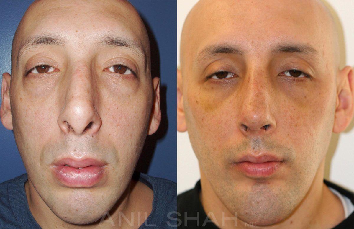 ATV reccomend Facial implants chicago
