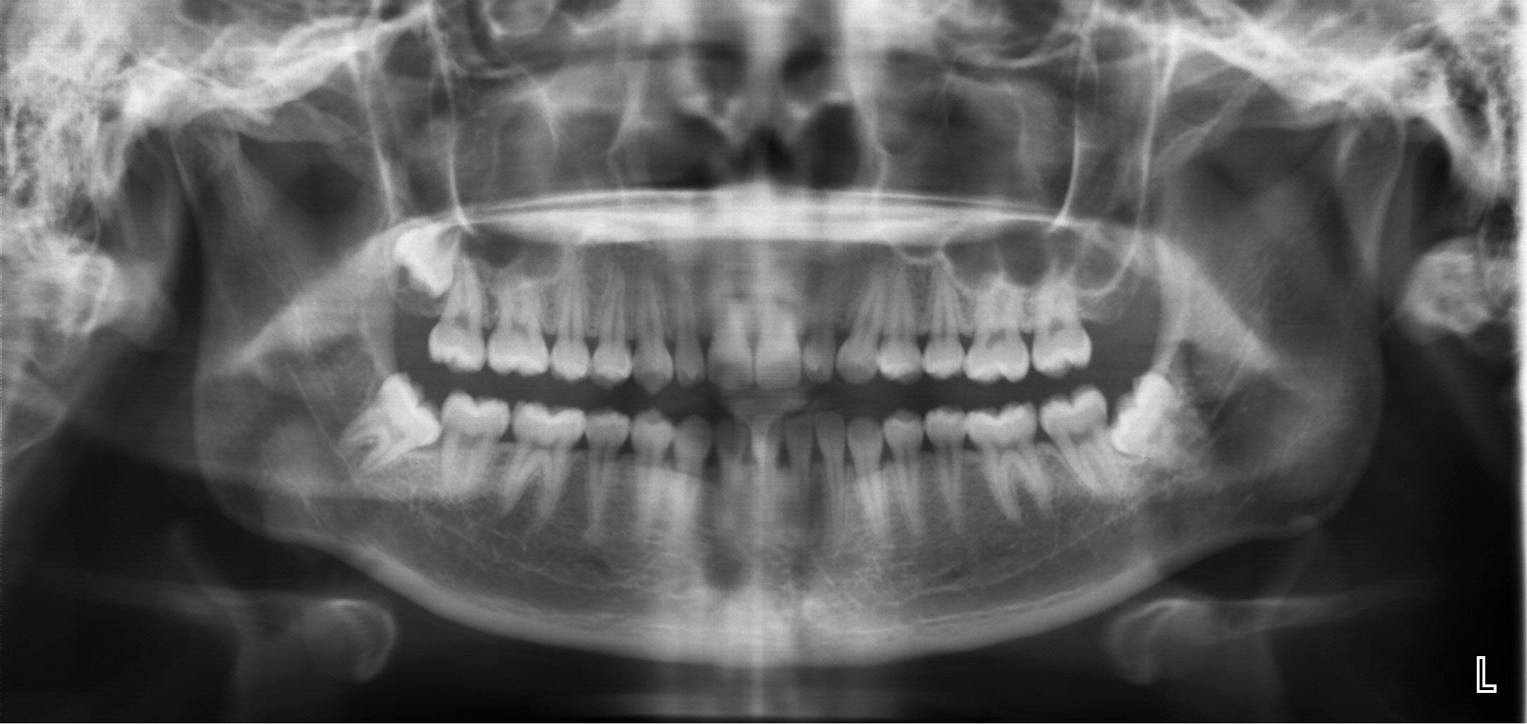 Patrol reccomend Impacted wisdom teeth and facial nerves