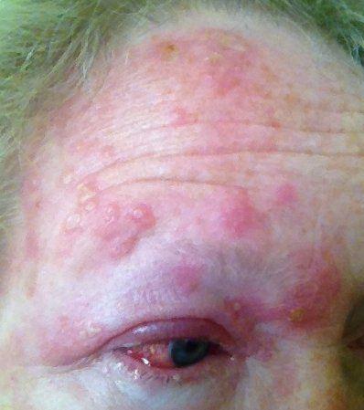 Lunar reccomend Facial zoster or shingles rash