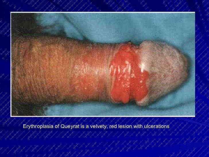 Butcher B. reccomend Tip of penis benign lesion