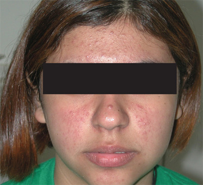 best of Left plaen of Excoriation facial
