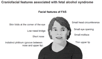 Tinkerbell reccomend Alcoholism facial deformity