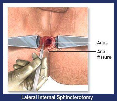 best of Surgery Anal skin tag