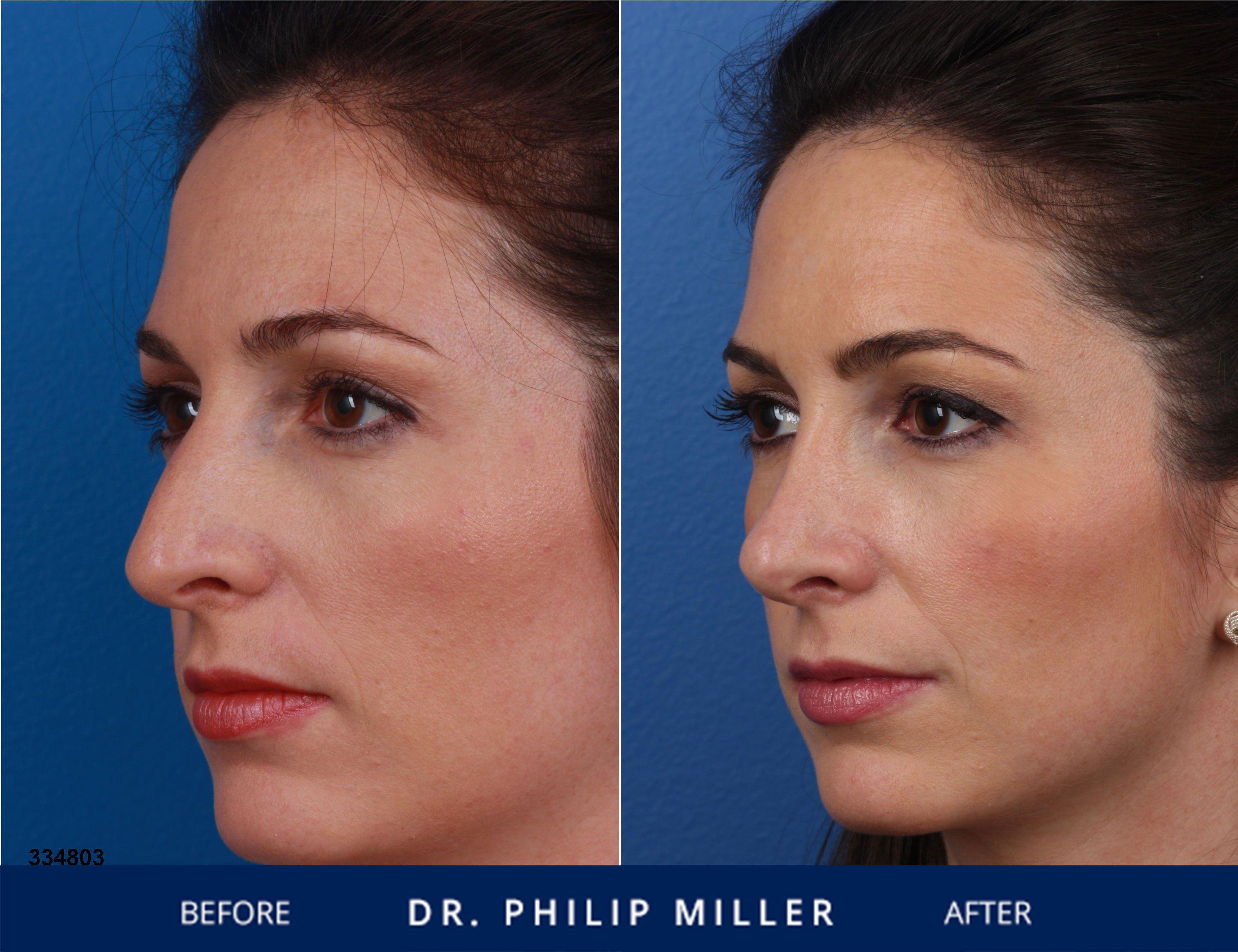 best of Rhinoplasty dr Gallery Asian 2018 Pics