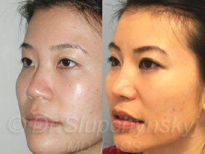 best of Rhinoplasty dr Gallery Asian 2018 Pics