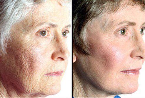best of Wrinkles Cosmetic surgery for facial