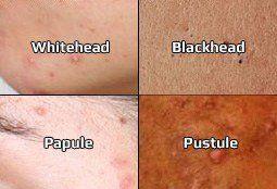 Highlander reccomend Types of facial acne