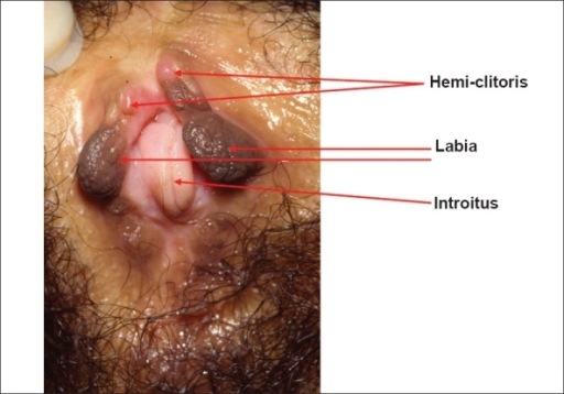 Clinical photographs of the female clitoris