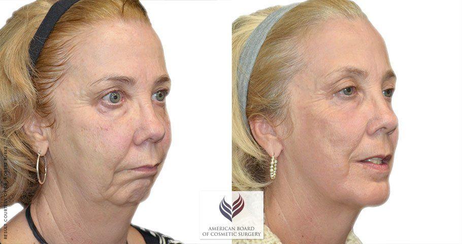Cosmetic surgery for facial wrinkles