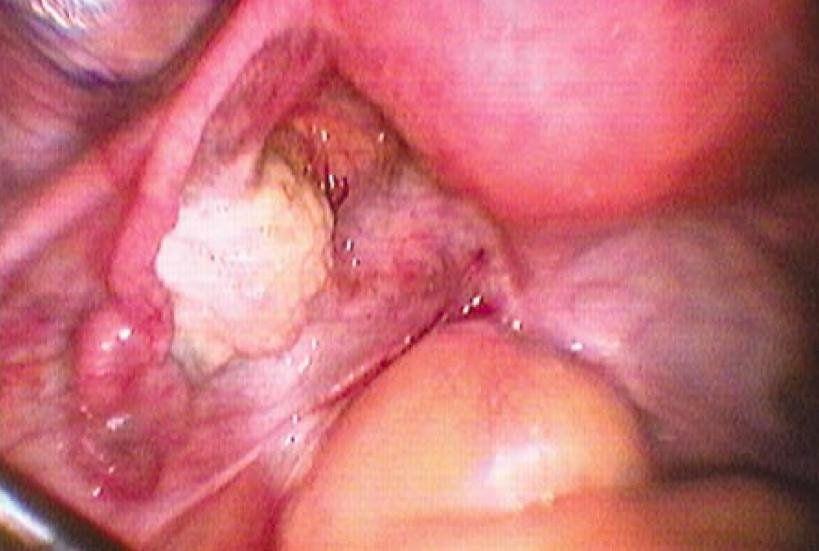 best of Vaginal lesion White