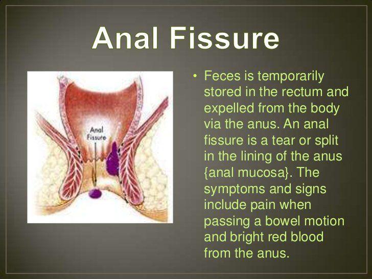 Feces stored in anus