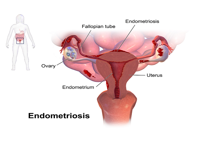 Tart reccomend Endometriosis in the clitoris