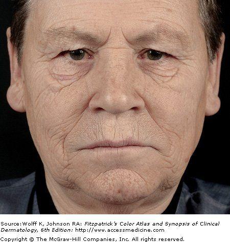 Excoriation of left facial plaen