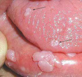 Moth reccomend Genital warts contracted oral sex