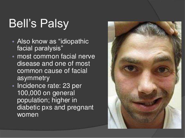 best of Palsy Idiopathic facial