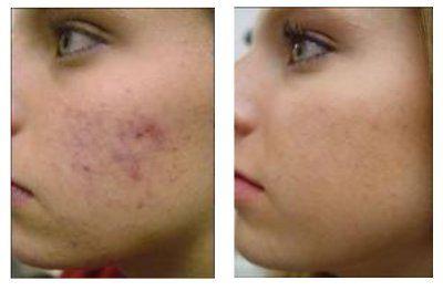 Facial peel for acne