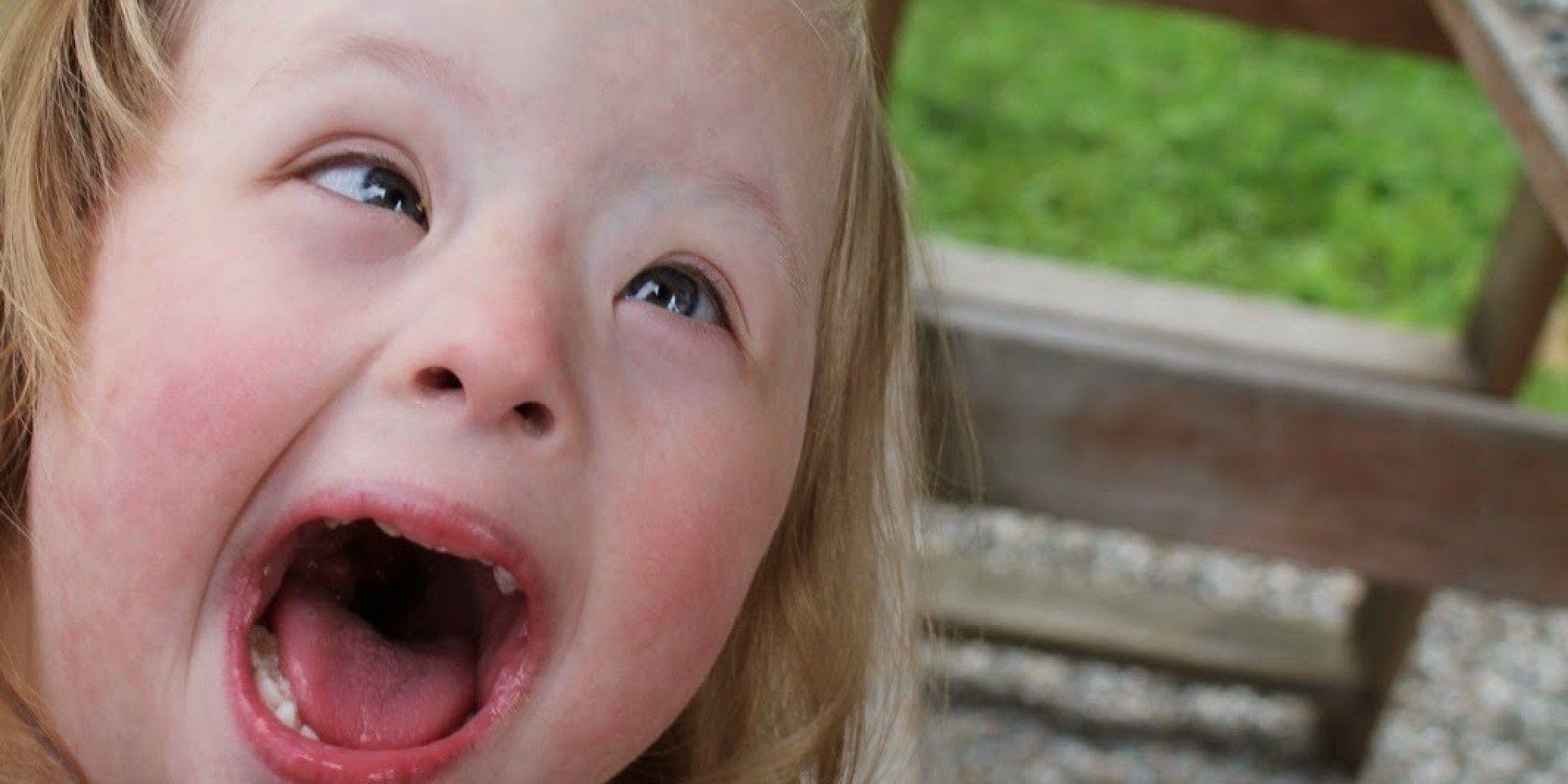 Facial effects down of syndrome