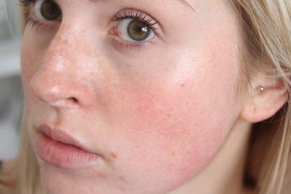 Facial rashes due to rheumatoid arthritis